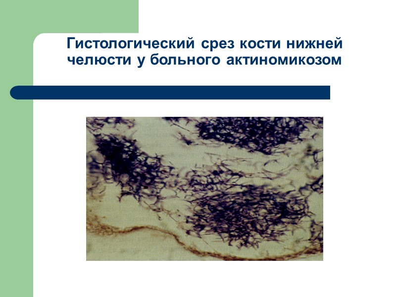Гистологический срез кости нижней челюсти у больного актиномикозом